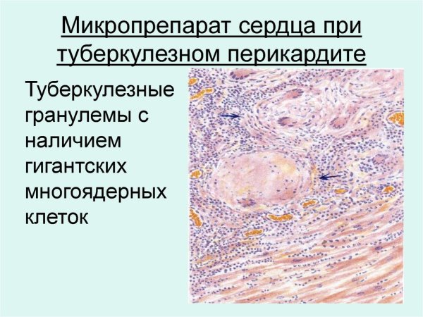 Фибринозный перикардит микропрепараты
