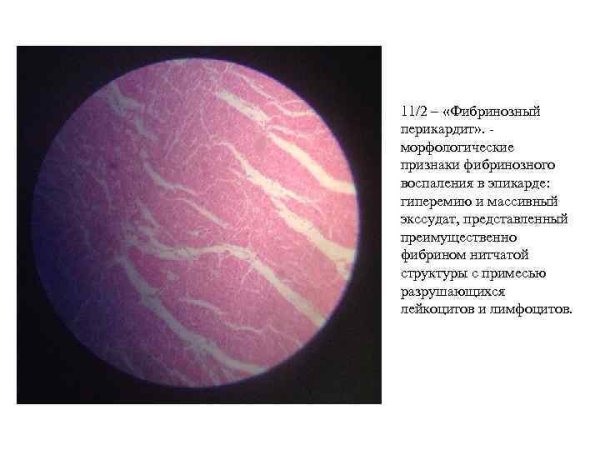 Фибринозный перикардит препарат патанатомия