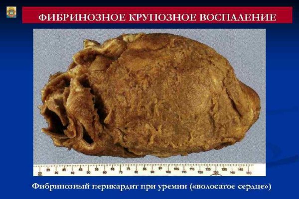 Фибринозный перикардит