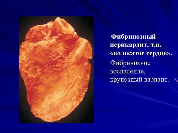 Фибоинозный эпикардит