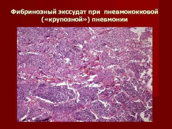 Крупозное фибринозное воспаление