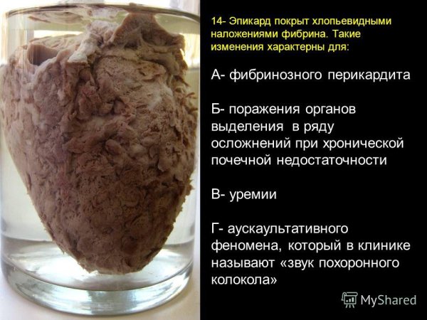 Фиброзный перикардит макропрепарат