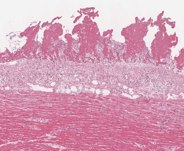 Фибринозный эп икардит патанатомия