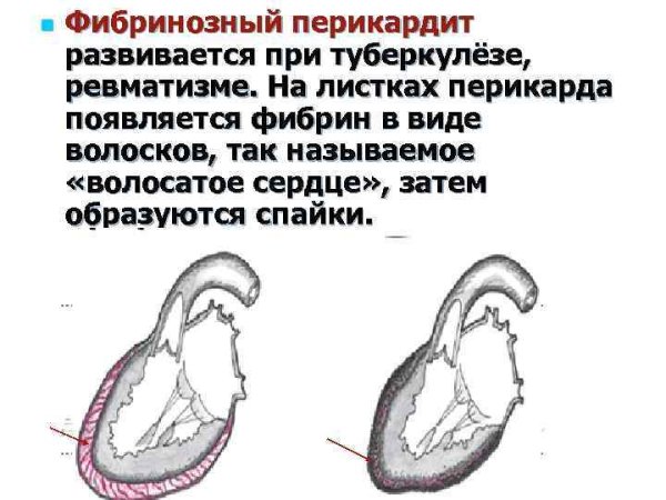 Фибринозный перикардит КРС