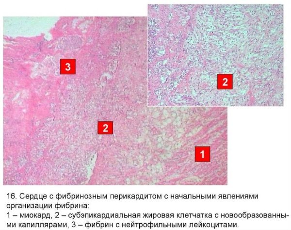 Фибринозный перикардит микропрепарат патанатомия