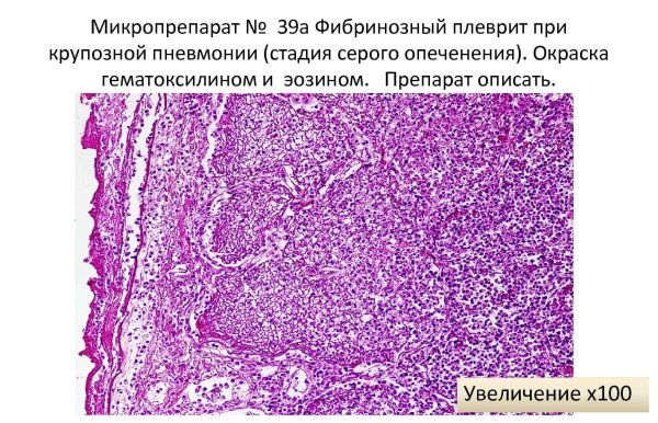 Фибринозная пневмония патанатомия