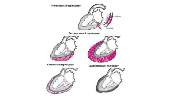 Сухой и экссудативный перикардит