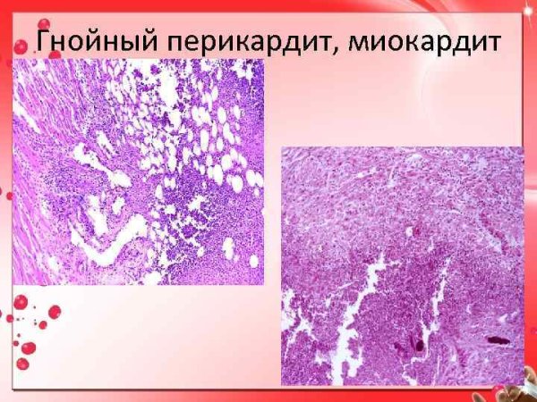 Серозный перикардит гистология