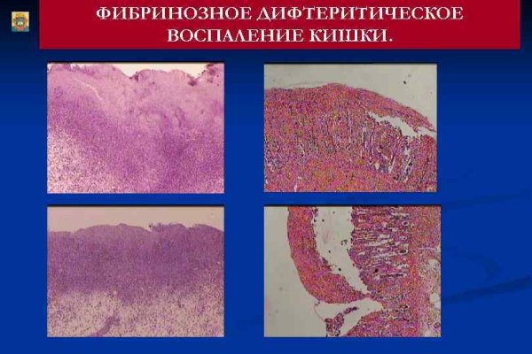 Фибринозное воспаление патанатомия