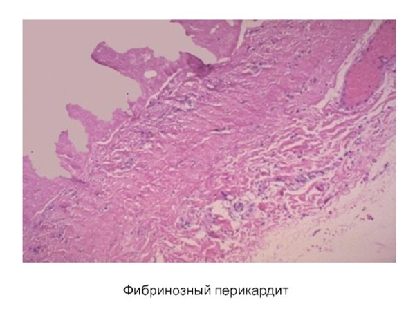 Фибринозный перикардит гистология