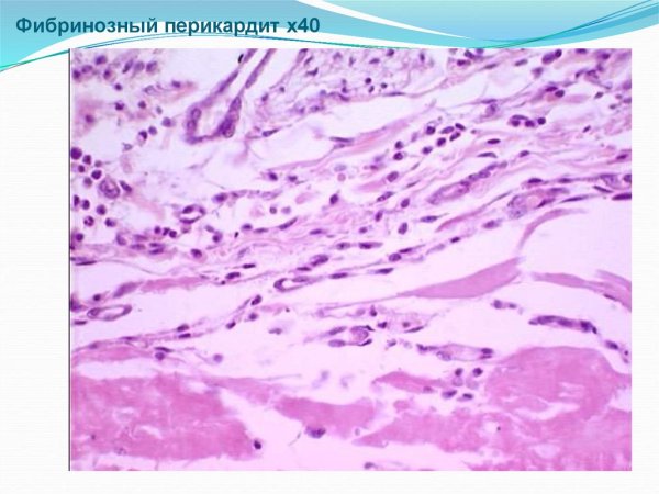 Фибриноидный перикардит
