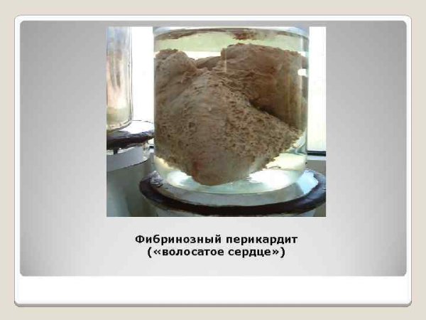 Фибринозный перикардит ("волосатое сердце") макропрепарат