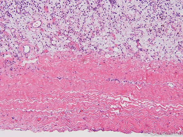 Фибринозный перикардит патанатомия