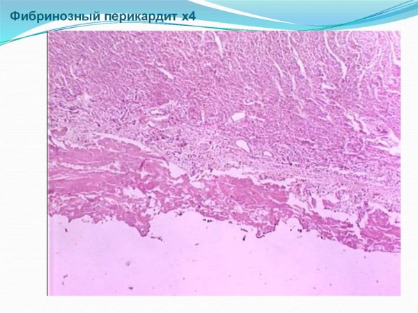 Фибринозный перикардит