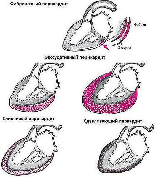 Слипчивый констриктивный перикардит