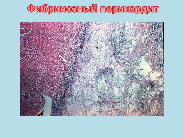 Фибринозное воспаление патанатомия