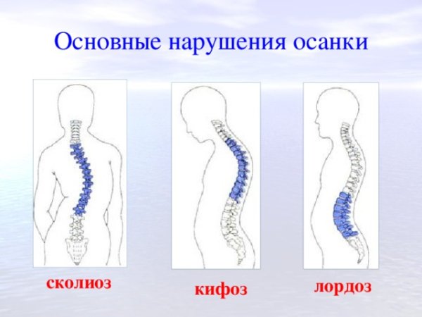 Искривление позвоночника лордоз кифоз