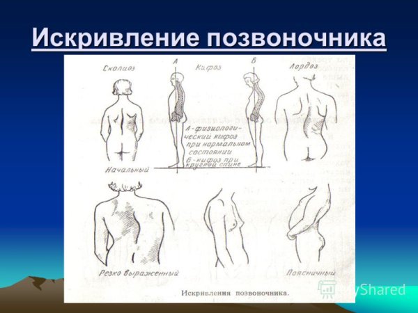 Гигиена искривления позвоночника