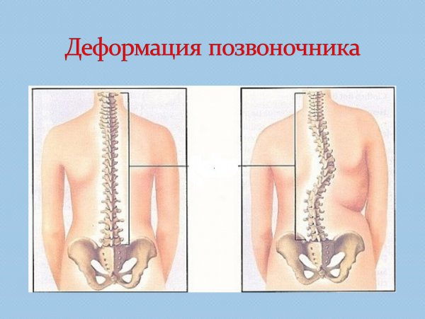 Искривление позвоночного столба