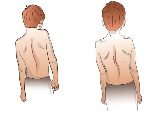 Инфантильный идиопатический сколиоз