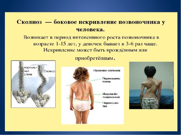 Причины искривления позвоночника