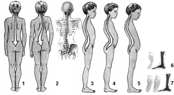 Деформации позвоночника ( сколиоз, лордоз, гиперкифоз)