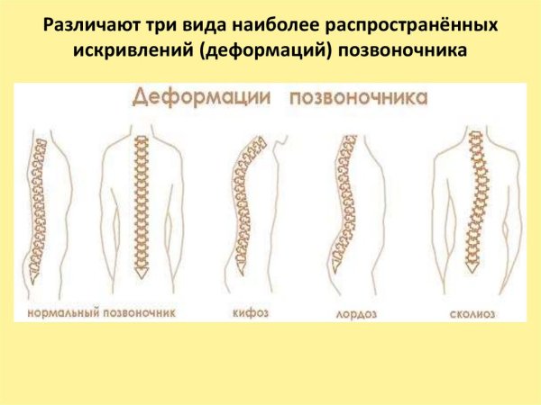 Три вида искривления позвоночника