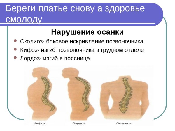 Формы искривления позвоночника