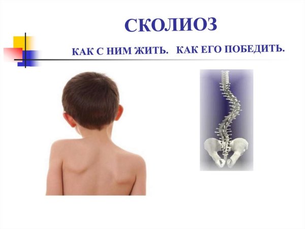 Сколиоз и его профилактика