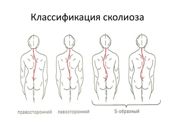 Правосторонний с образный сколиоз