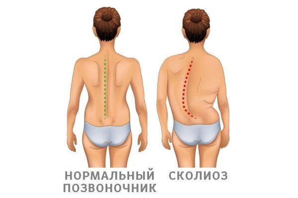 Сколиоз позвоночника у детей и подростков