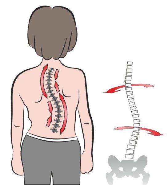Нуга Бест сколиоз лордоз