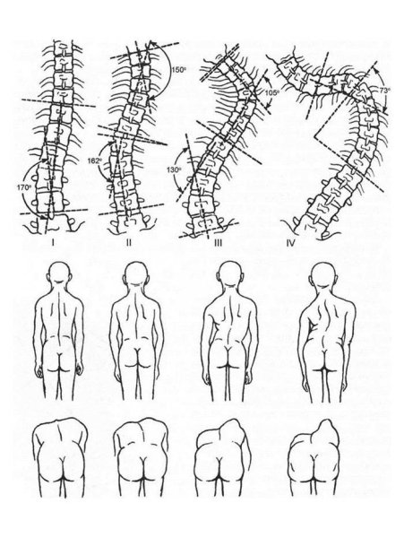 S образный сколиоз позвоночника 2 степени