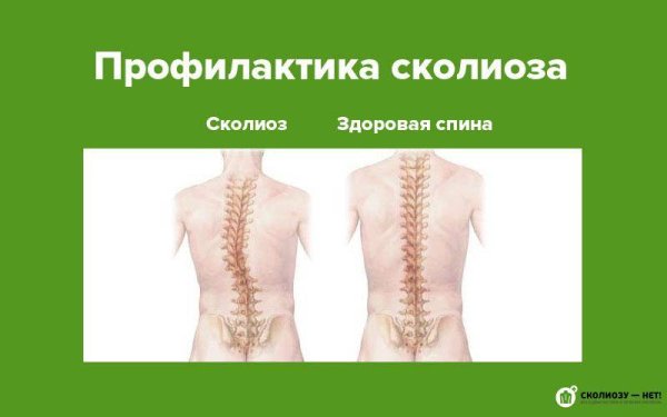 Профилактика сколиоза