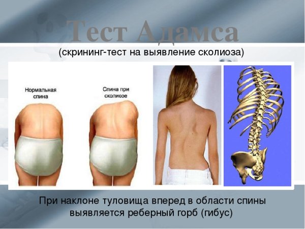Идиопатический сколиоз 2 степени у детей