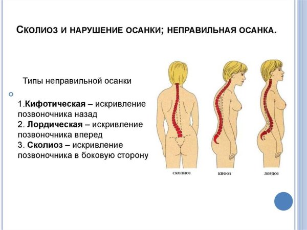 Выявление нарушение осанки сколиоз позвоночника