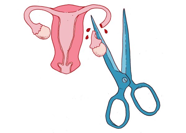 Хирургическая стерилизация вазэктомия