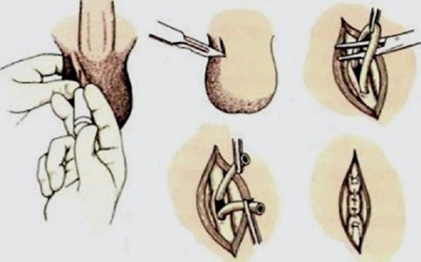 Вазорезекция этапы операции