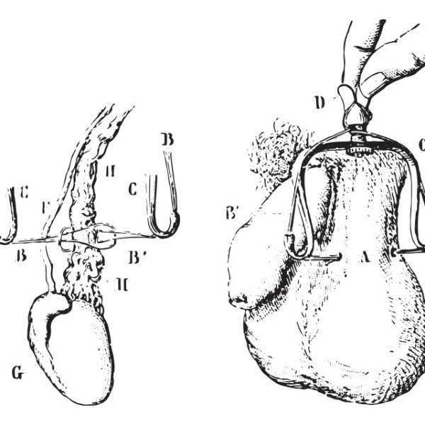 Кесарево сечение в древней Греции