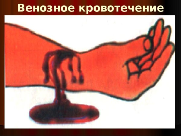 Венозное кровотечение кровотечение