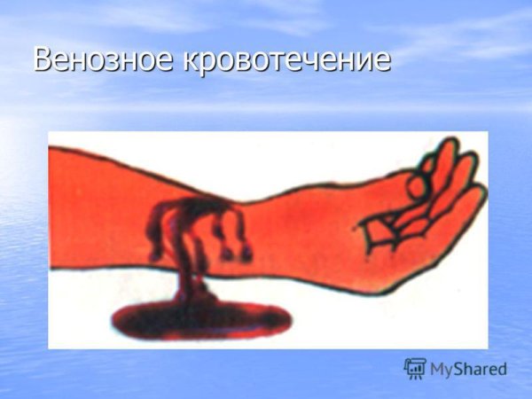 Открытое венозное кровотечение