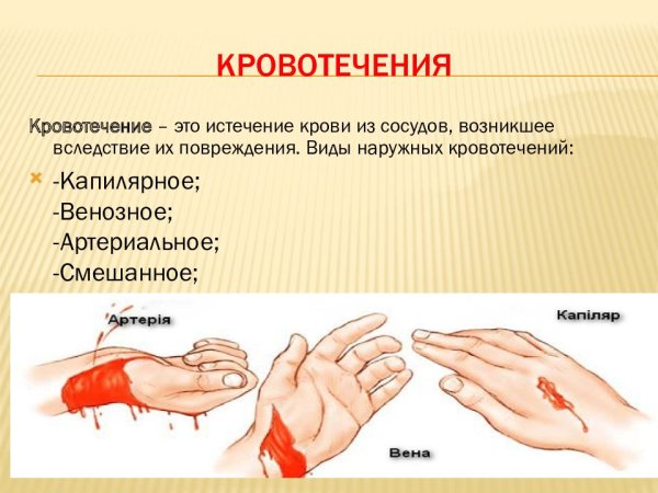 Наружное кровотечение
