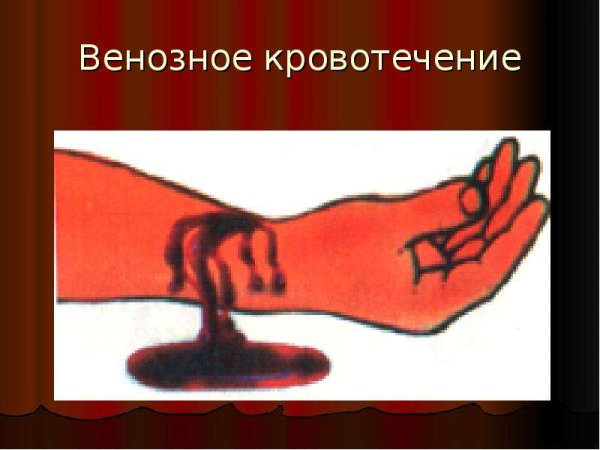 Наружное венозное кровотечение