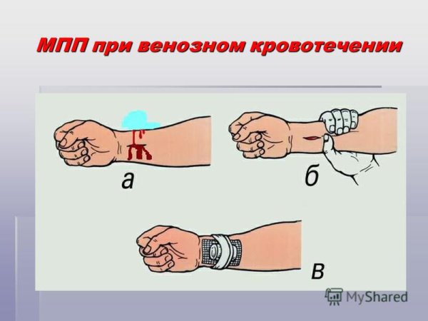 Венозное кровотечение ПМП