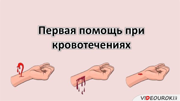 Первая помощь при кровотечениях