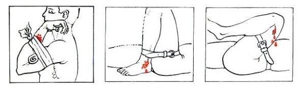 Капиллярное венозное артериальное тканевое кровотечение