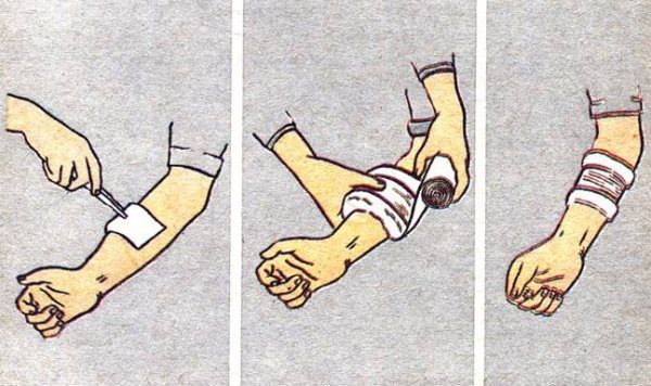 Венозное кровотечение ПМ