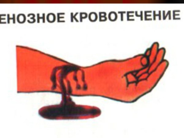 Венозное кровотечение первая