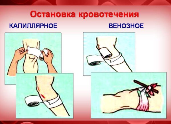 Остановка капиллярного и венозного кровотечений
