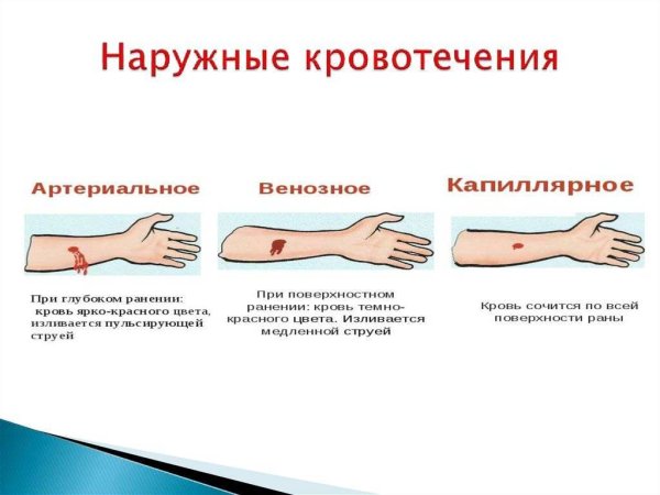 Капиллярное, венозное, артериальное, внутреннее кровотечения
